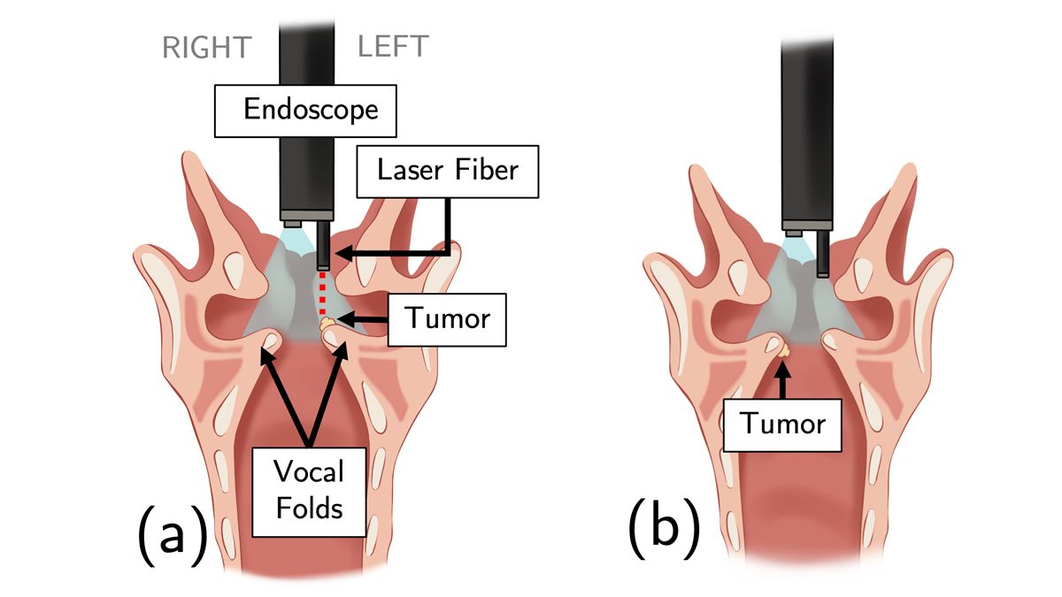 Una ilustración muestra un tumor encima de las cuerdas vocales que se puede ver con una fibra láser plana. La segunda ilustración muestra que si el tumor está debajo de las cuerdas vocales, no se puede ver.