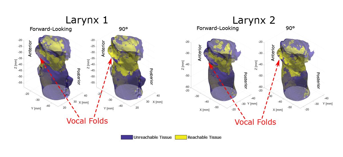 Larynx simulations that compare the areas reachable by forward-looking fibers versus 90° fibers and demonstrate that the 90° fiber reaches more area.