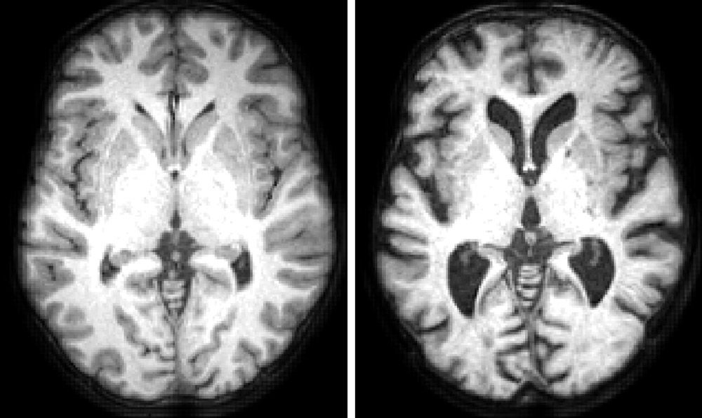 Figure 1. Structural MRI images showing a horizontal section through a typical healthy 19-year old and the brain of a typical healthy 86-year old.