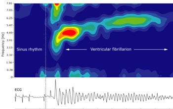 Figure 4.  Time-frequency analysis of ventricular fibrillation.  Frequency peaks in the range of 3-6Hz indicate fibrillation or flutter.