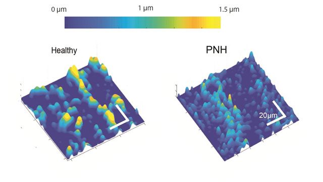 Results showing healthy platelets and those with paroxysmal nocturnal hemoglobinuria (PNH).