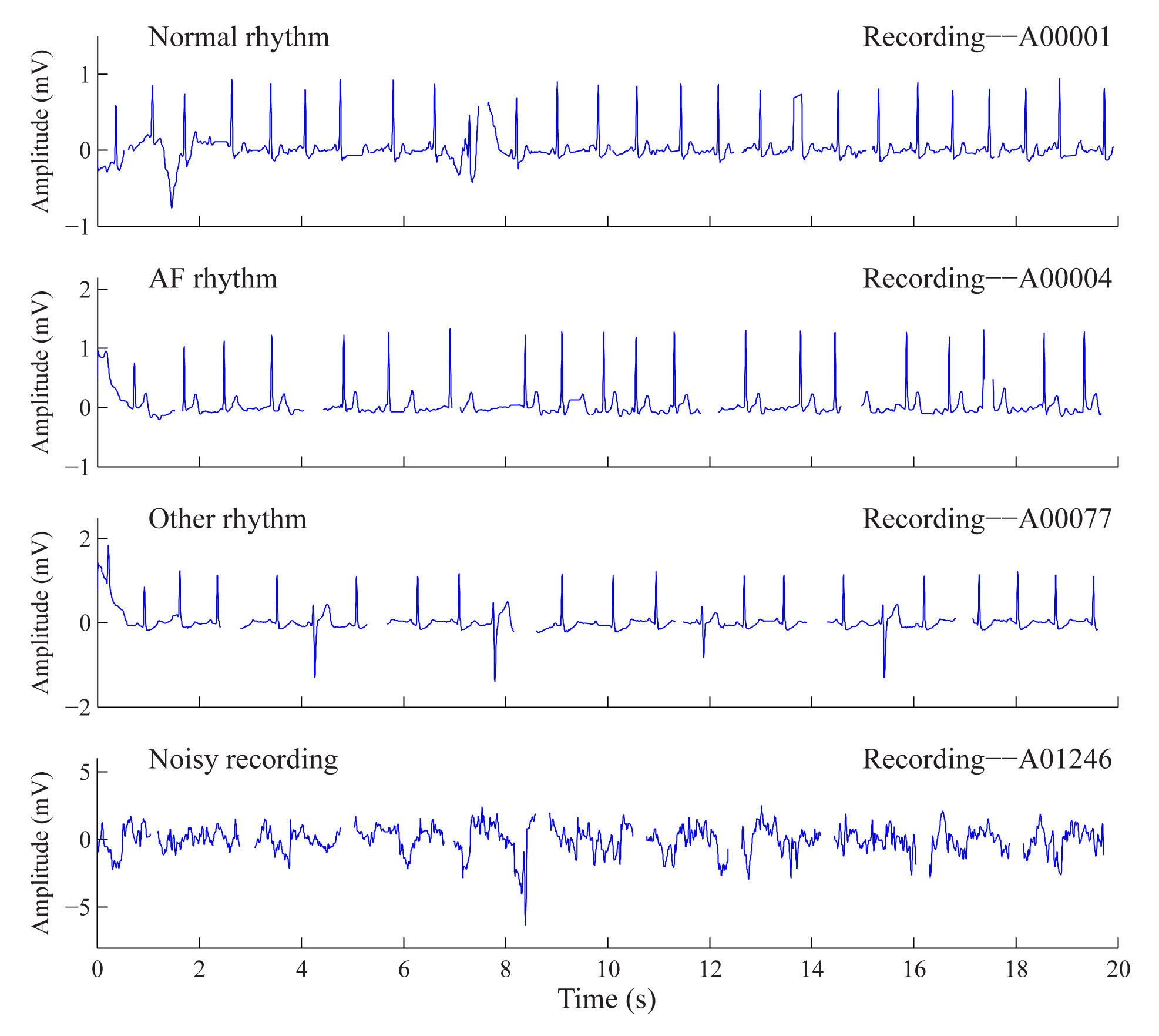 The George B. Moody PhysioNet Challenge - MATLAB & Simulink