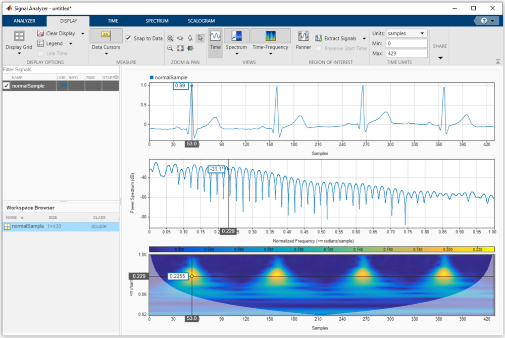 Biomedical Signal Processing - MATLAB & Simulink