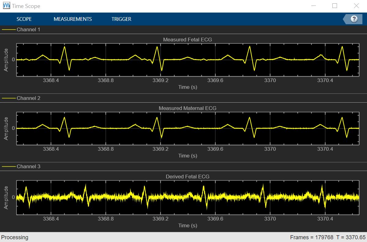 Apply Adaptive Noise Canceling to Fetal Electrocardiography