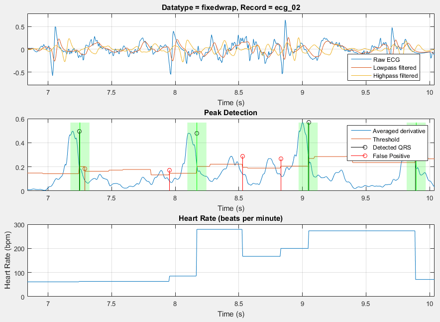 parfor-plot-bad-ecg_02.png