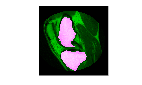 Use Freehand ROIs to Refine Segmentation Masks