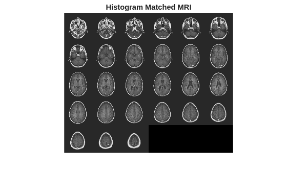 Figure contains an axes object. The hidden axes object with title Histogram Matched MRI contains an object of type image.