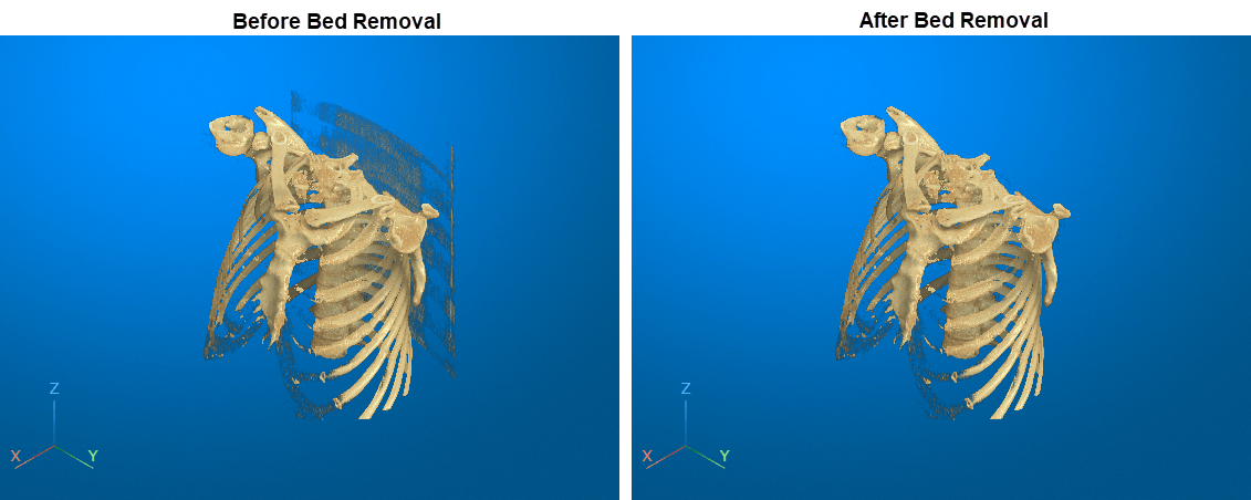 Side-by-side comparison of a chest CT display before and after removing the bed