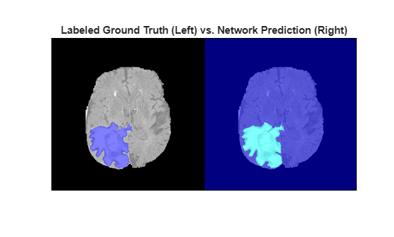 3-D Brain Tumor Segmentation Using Deep Learning