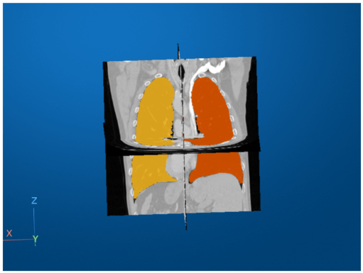 Rotated slice planes display, showing the left and right lung labels in the coronal plane