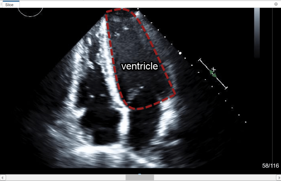 Slice pane with ventricle region to label circled