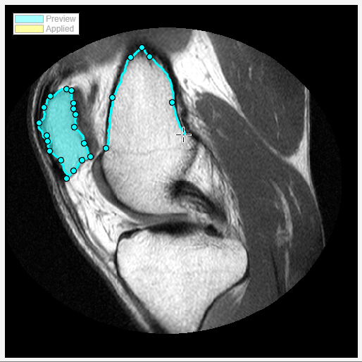 Preview of segmented knee using Assisted Freehand ROI.