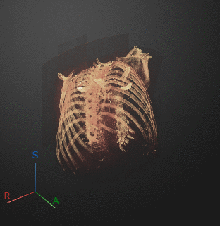 Animation of 3-D chest CT exported from the app