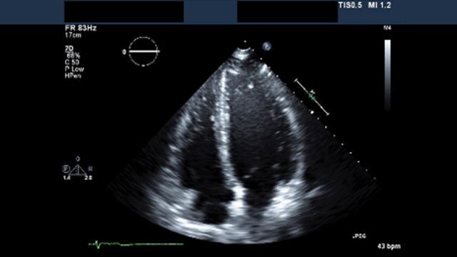 Primer fotograma de una serie de imágenes de ultrasonido de un ecocardiograma.