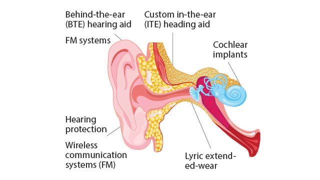 Sonova reduce el tiempo de desarrollo de productos para audífonos e implantes auditivos con el diseño basado en modelos